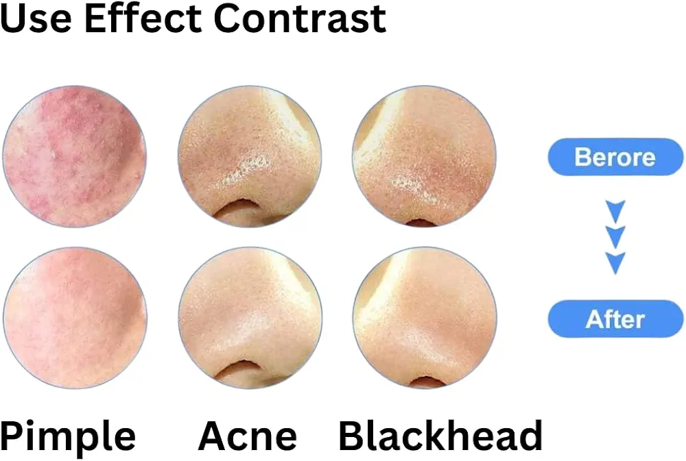 bron stick pimple and black head remover stainless steel premium quality image 3